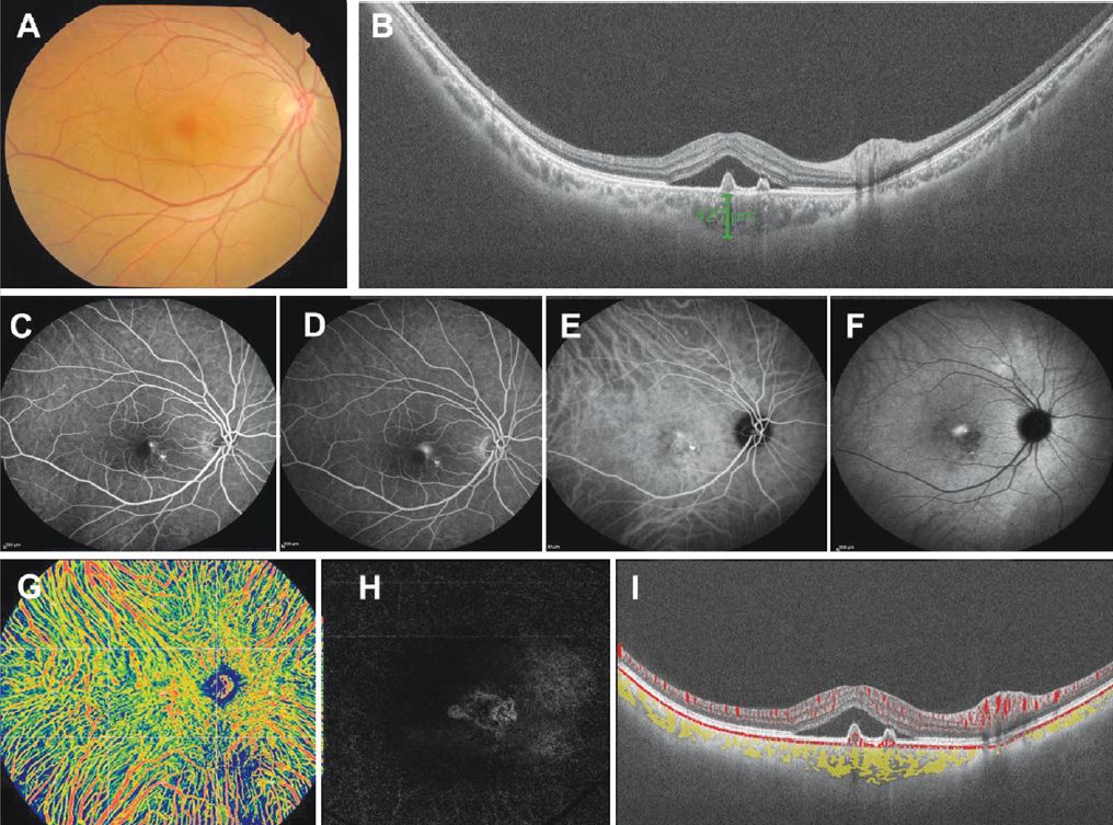 UWF choroidal changes in cCSC with MNV investigated by full-range SS-OCTA TowardPi.jpg