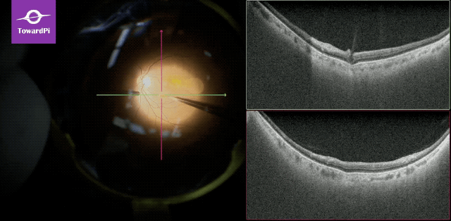 Meticulously precise subretinal injection guided by intraoperative SS-OCT2.gif