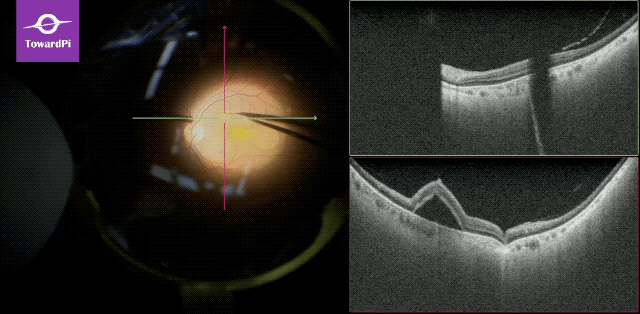 Meticulously precise subretinal injection guided by intraoperative SS-OCT1.gif