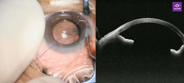 Precise glaucoma surgeries guided by full range intraoperative SS-OCT_gif.gif