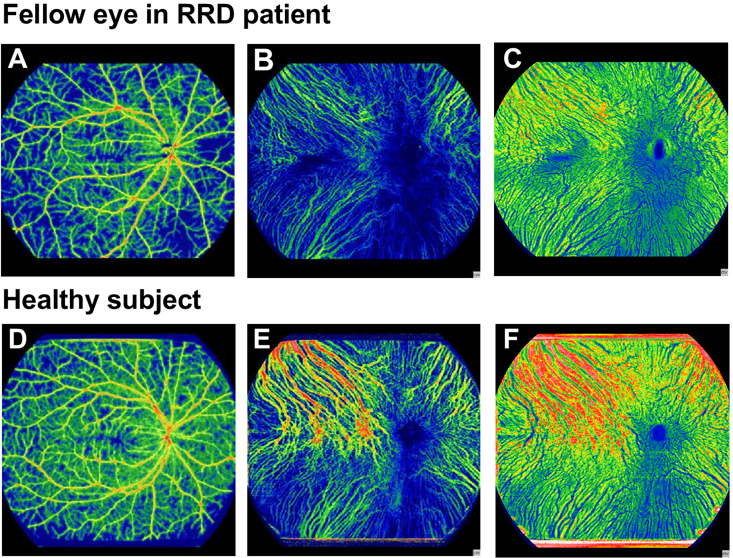 Beware the fellow eyes in retinal detachment.png