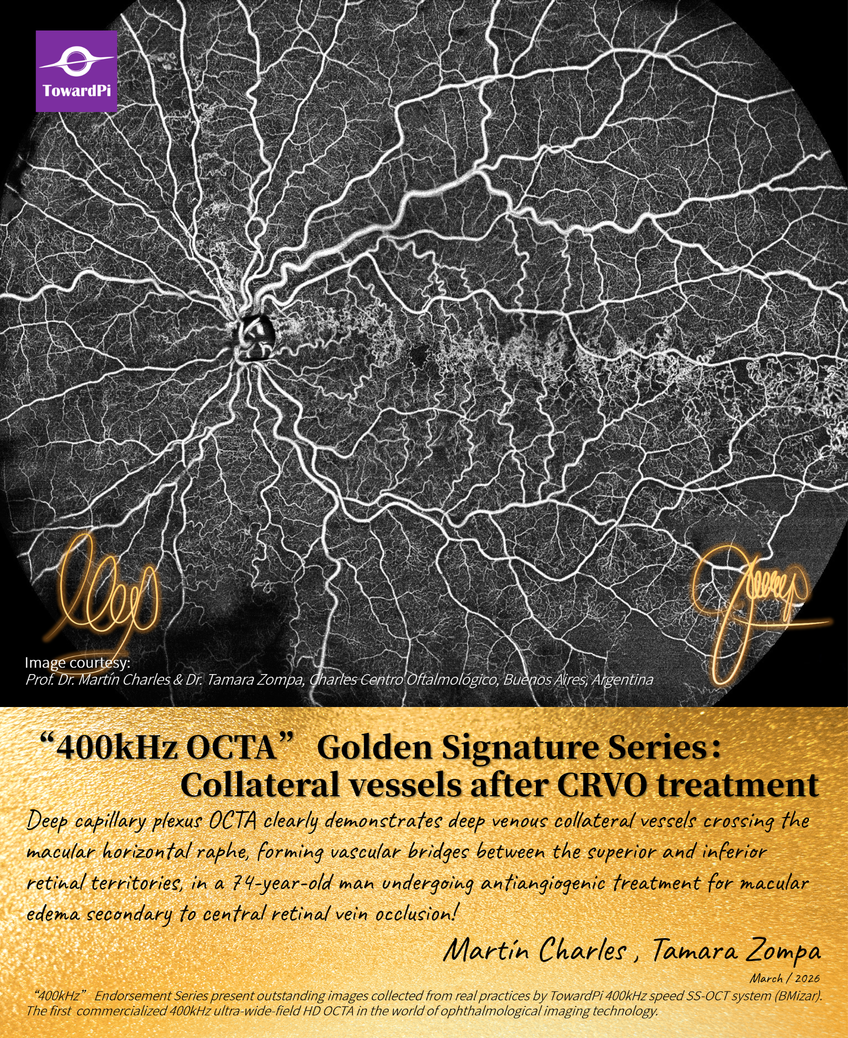 Collateral vessels after CRVO treatment_reduced size.png