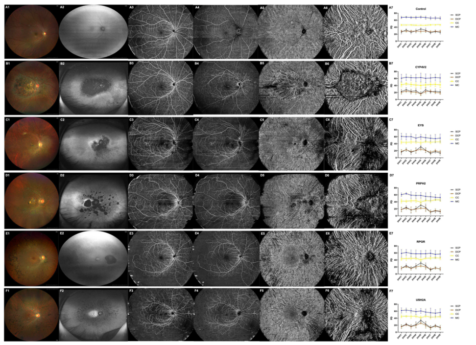 Genotype-specific choroidal characteristics in RP revealed by UWF SS-OCTA_2.png