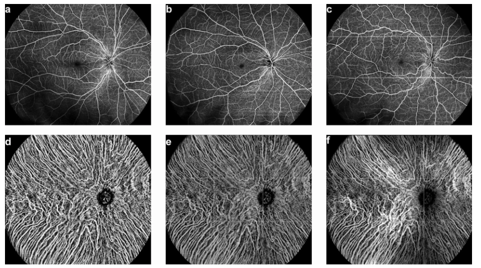 Relationship Between Age, AL and Choroidal Vasculature Characteristics Revealed by UWF Full-Range SS-OCTA_ article.png