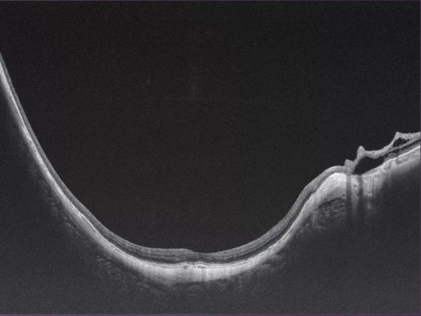 高度近视（16mm 横向，6mm 纵深）