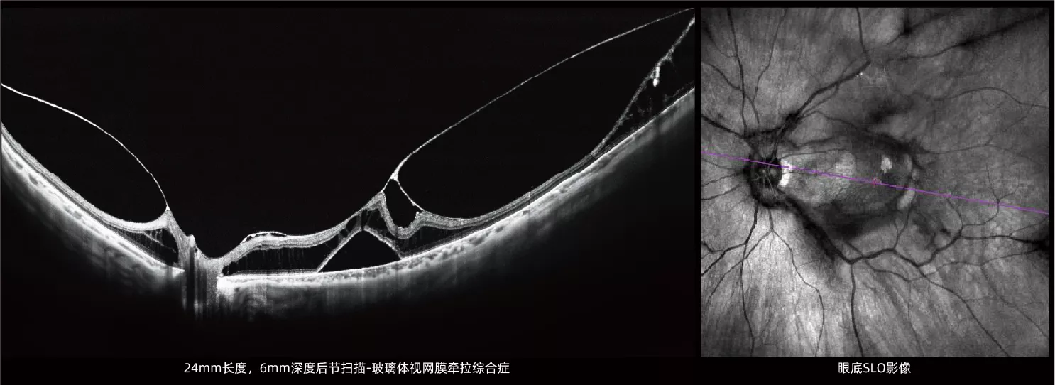 玻璃体视网膜牵拉综合症