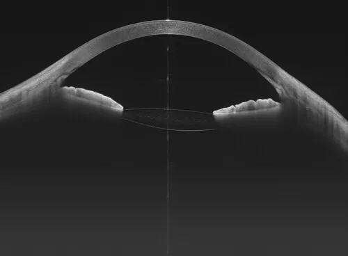Intraocular lens