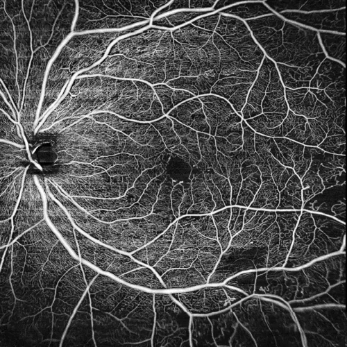 Diabetic retinopathy (12×12mm OCTA)