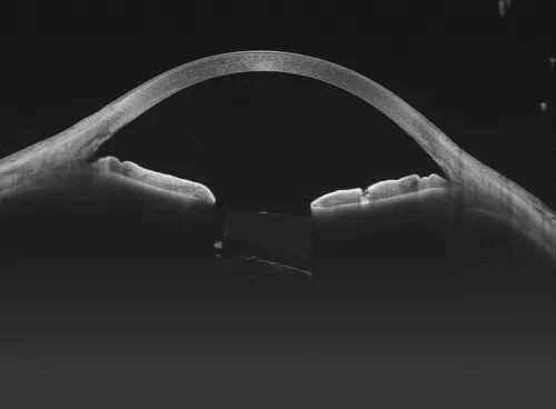 Intraocular lens and anterior vitreous body