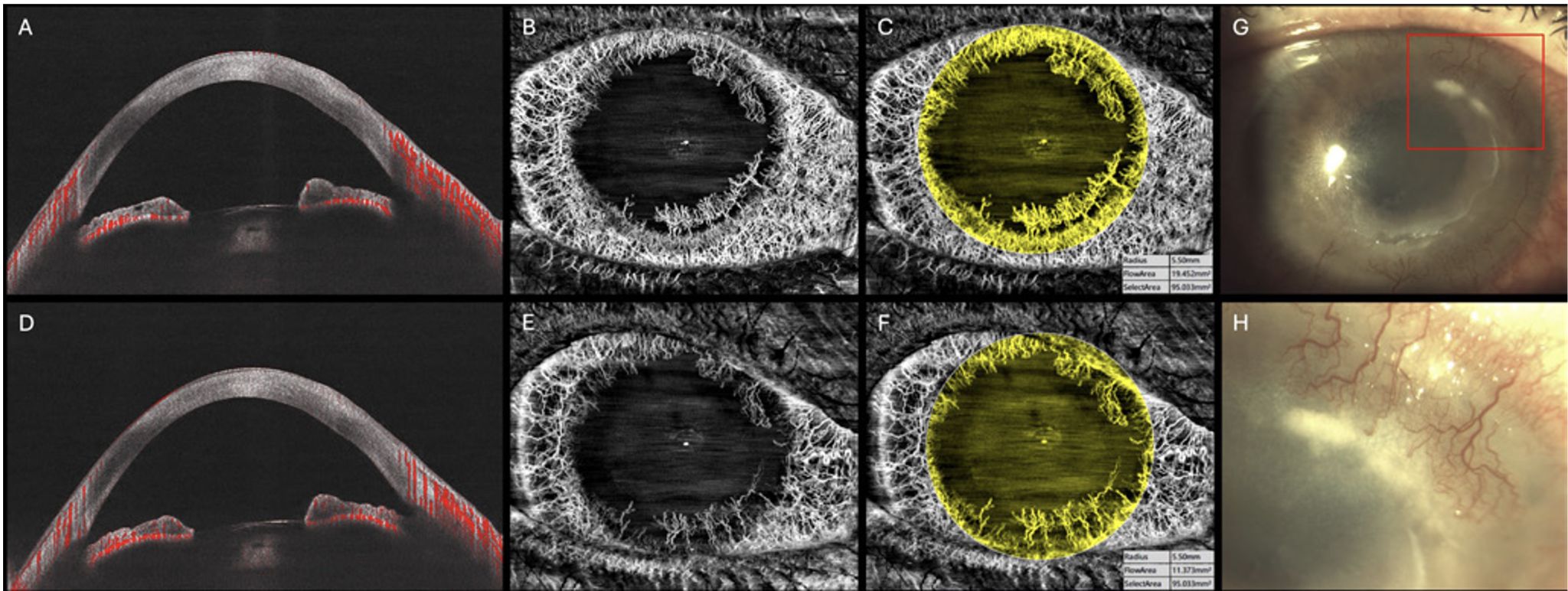 Advanced imaging of corneal neovascularization with full-range SS AS-OCTA TowardPi.jpg