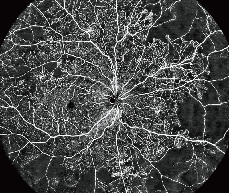Noninvasive evaluation of DR neovascularization using UWF full-range SS-OCTA.jpg