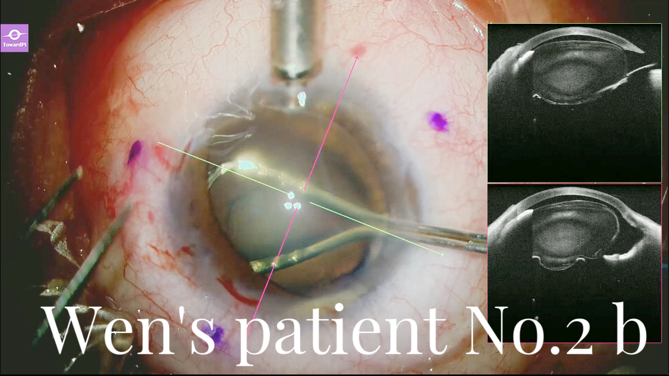 iOCT-Navigated Extraction of 320° Dislocated Lens2.jpg
