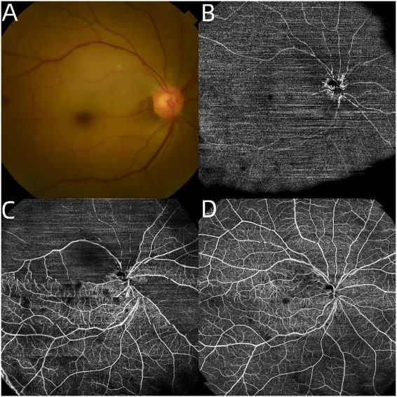 CRAO recanalization recorded by 400K speed SS-OCTA