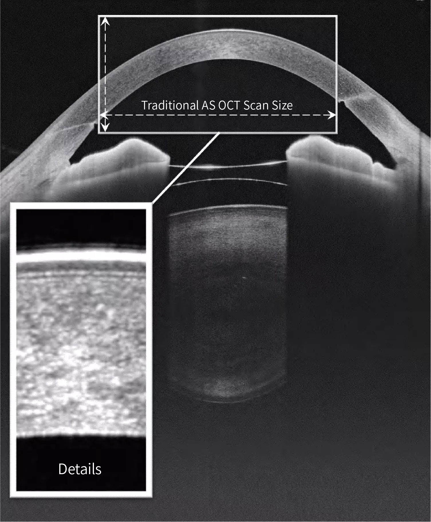 High Resolution Panoramic Anterior Segment