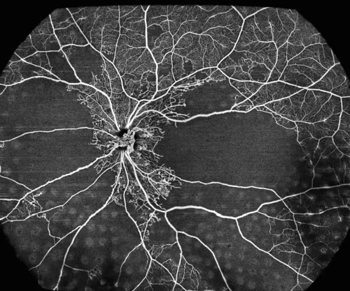Proliferative diabetic retinopathy, image Credit: Professor Chen Youxin