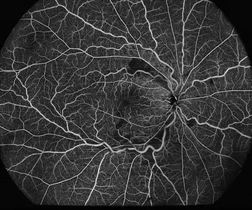 Retinal vasculitis, image credit: Dr. Sun Yaoyao