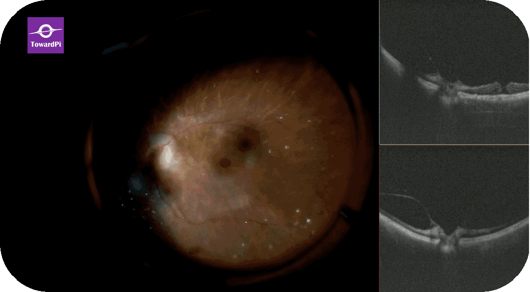TowardPi intra-operative OCT microscope.gif