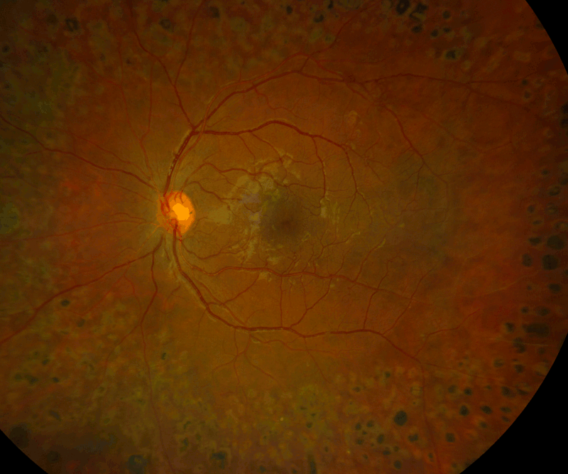 Customized laser therapy navigated by UWF full range OCTA_gif.gif