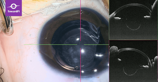 Precise pediatric cataract surgery guided by SS-iOCT 1.gif