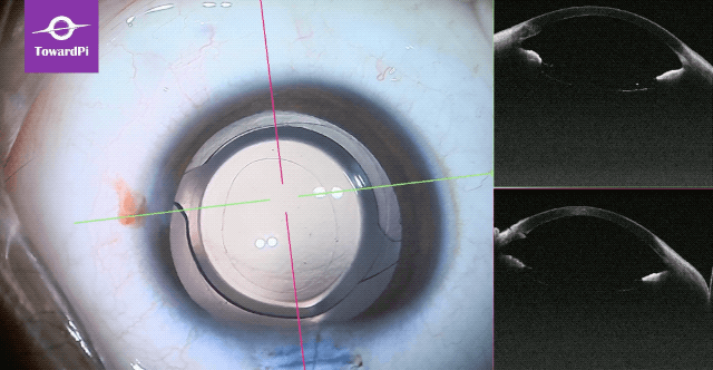 Precise pediatric cataract surgery guided by SS-iOCT 3.gif