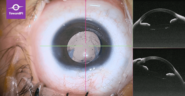 Precise pediatric cataract surgery guided by SS-iOCT 5.gif