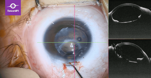 Precise pediatric cataract surgery guided by SS-iOCT 4.gif