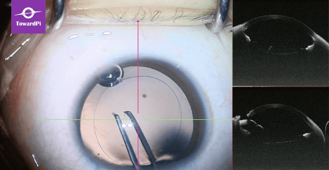 Precise pediatric cataract surgery guided by SS-iOCT 2.gif