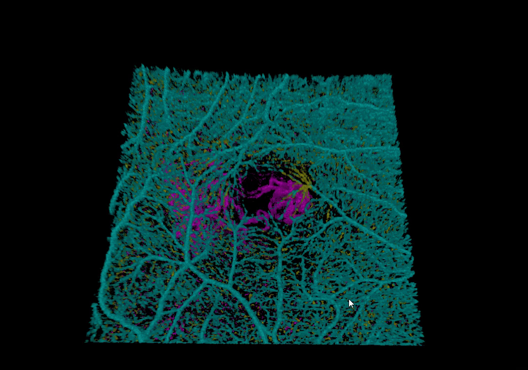 3D OCTA-Choroidal Neovascularization