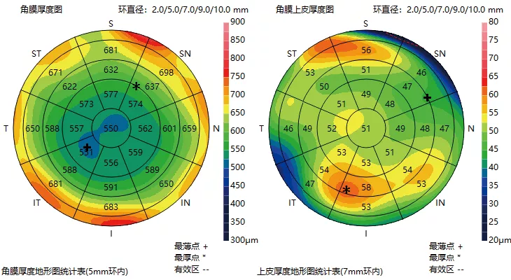 角膜厚度图和上皮厚度图量化分析