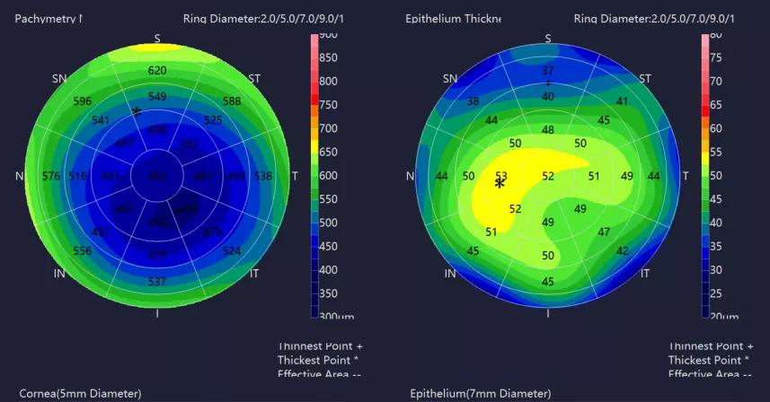 Cornea Thickness Map and Epithelium Thickness Map