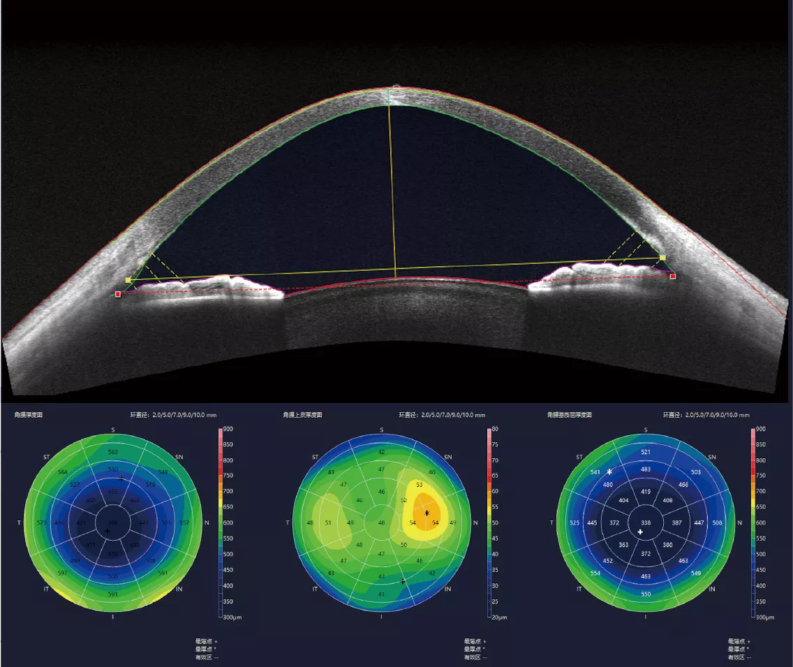 Corneal pachymetry, epithelium thickness, stroma thickness, etc.