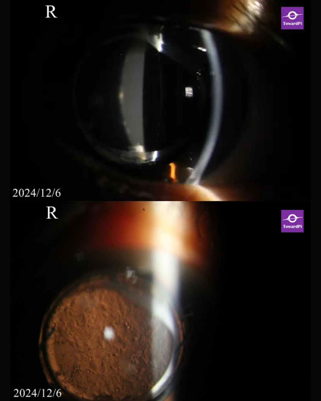 Secret in the Capsule—a CBS Case Revealed by Full-Range SS AS-OCT_3.png