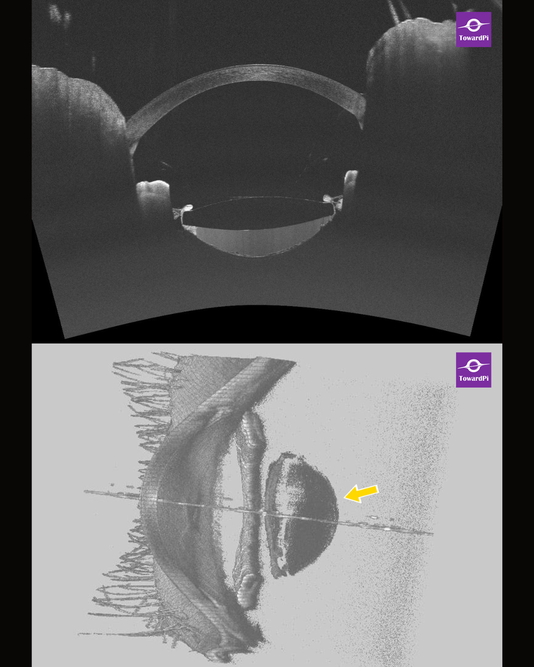 Secret in the Capsule—a CBS Case Revealed by Full-Range SS AS-OCT_2.png