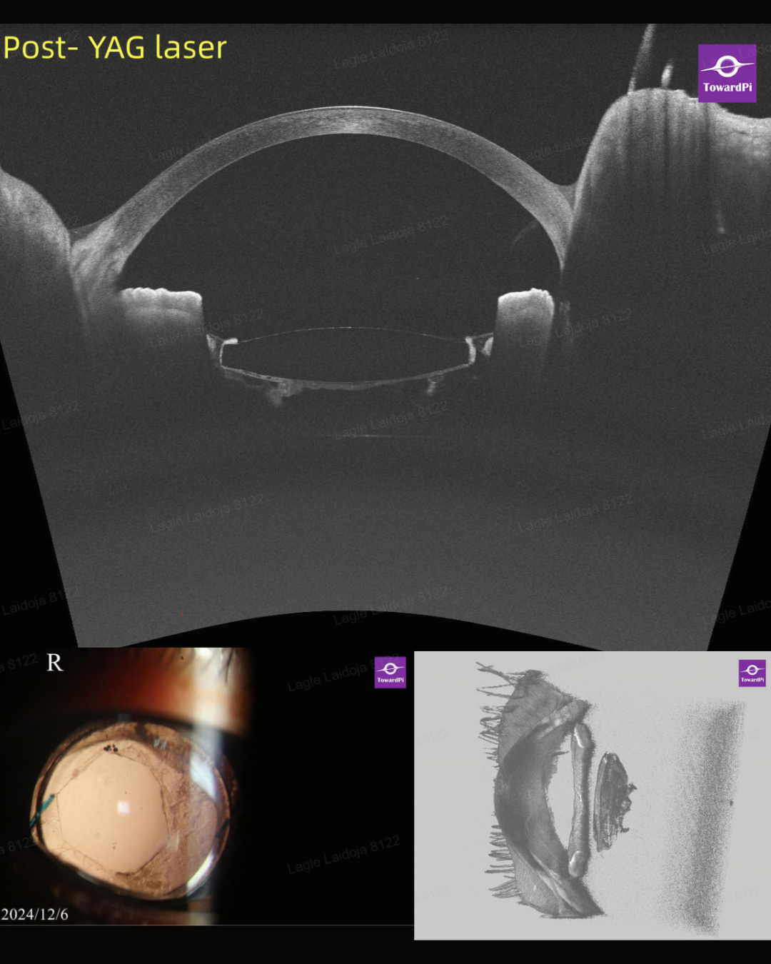 Secret in the Capsule—a CBS Case Revealed by Full-Range SS AS-OCT1_1.png