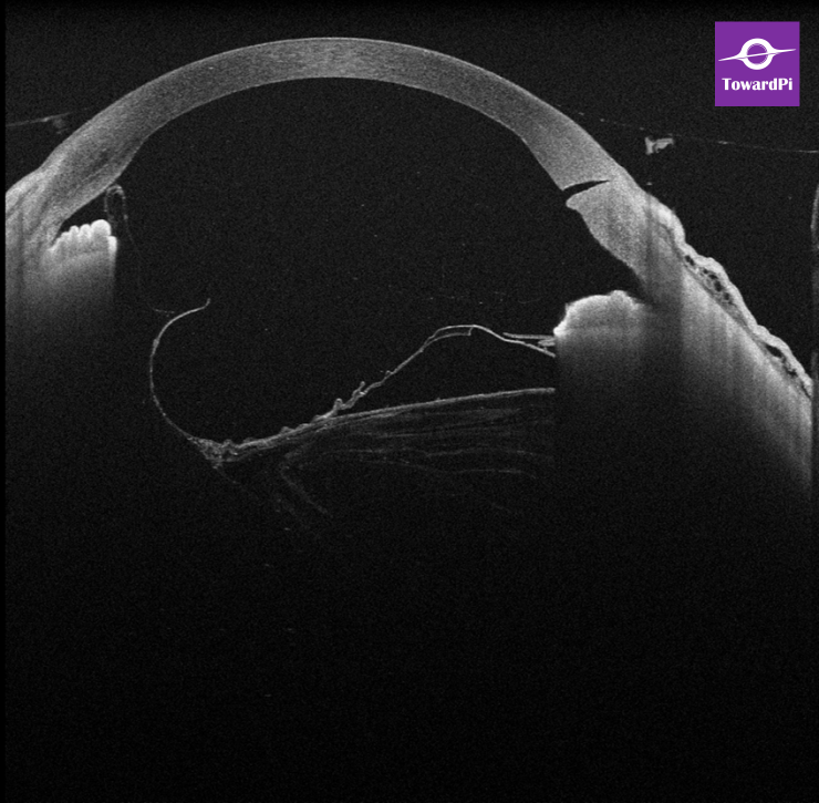 Real-time precision in complex cataract surgery for lens subluxation guided by iOCT1.png