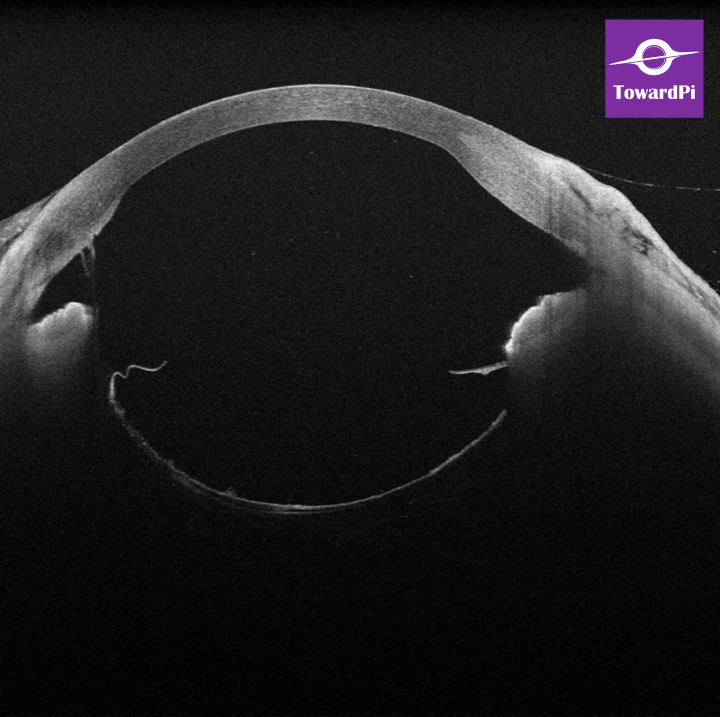 Real-time precision in complex cataract surgery for lens subluxation guided by iOCT2.png