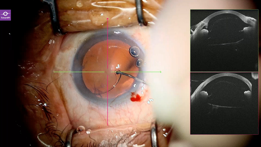 Real-time precision in complex cataract surgery for lens subluxation guided by iOCT3.png