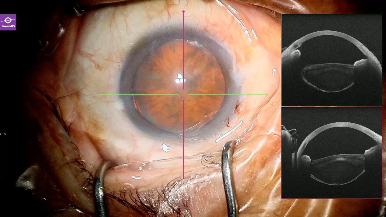 Real-time precision in complex cataract surgery for lens subluxation guided by iOCT5.png