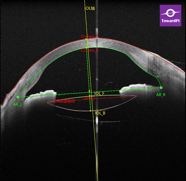 Real-time precision in complex cataract surgery for lens subluxation guided by iOCT4.png