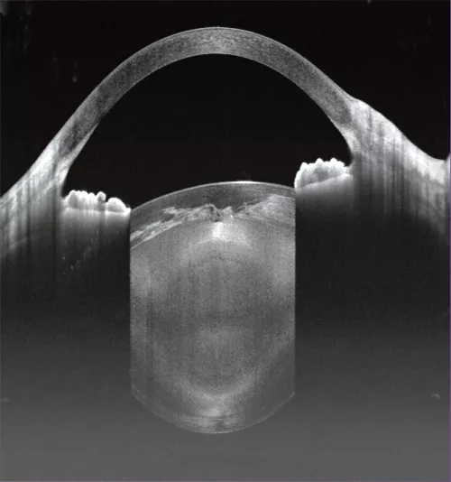 Panoramic anterior segment - cataract