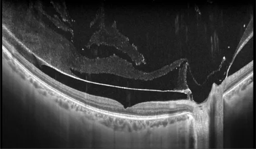 Posterior vitreous detachment
