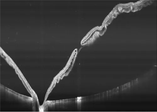Extensive retinal detachment