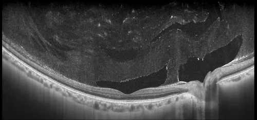 Anterior pouch of posterior vitreous cortex