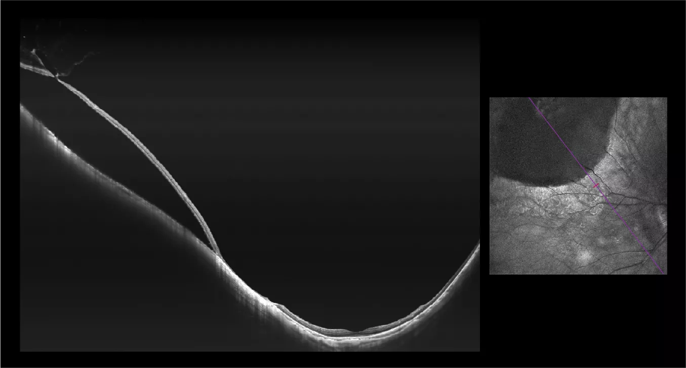 24mm wide，12mm deep-Retinal detachment