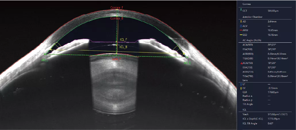18mm length，6mm scan depth- Anterior segment (AS) OCT with auto matic measurement