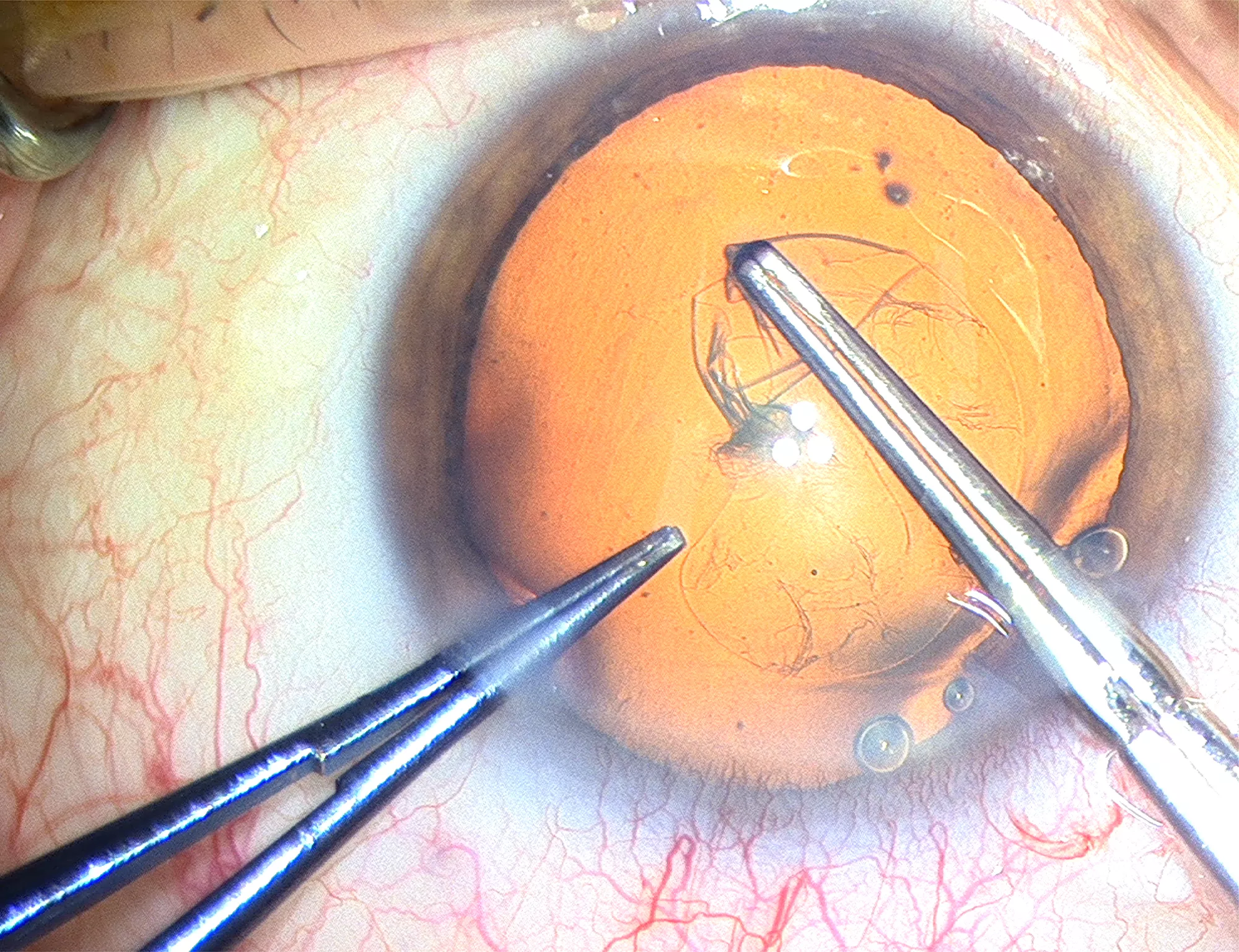 4K3D red reflex in cataract surgery