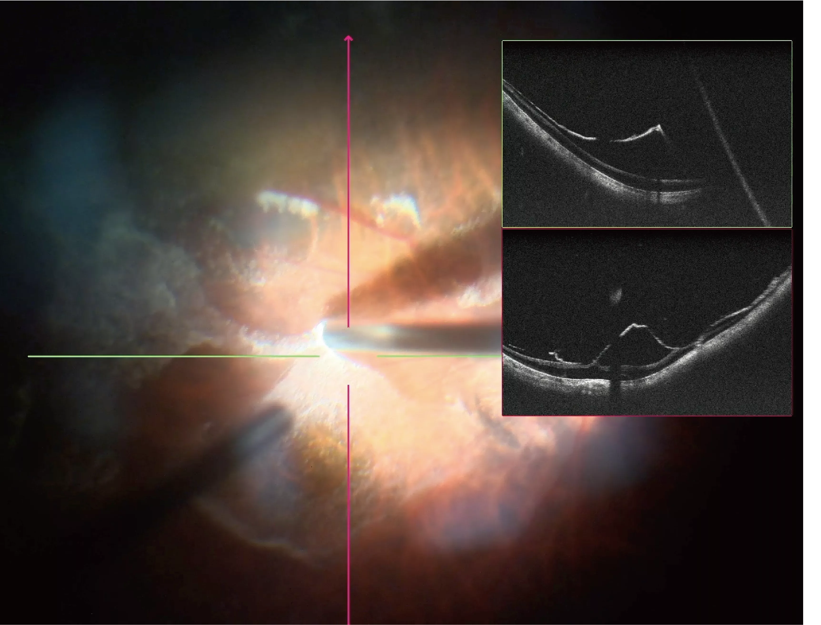 Real-time intraoperative SS-OCT in vitrectomy