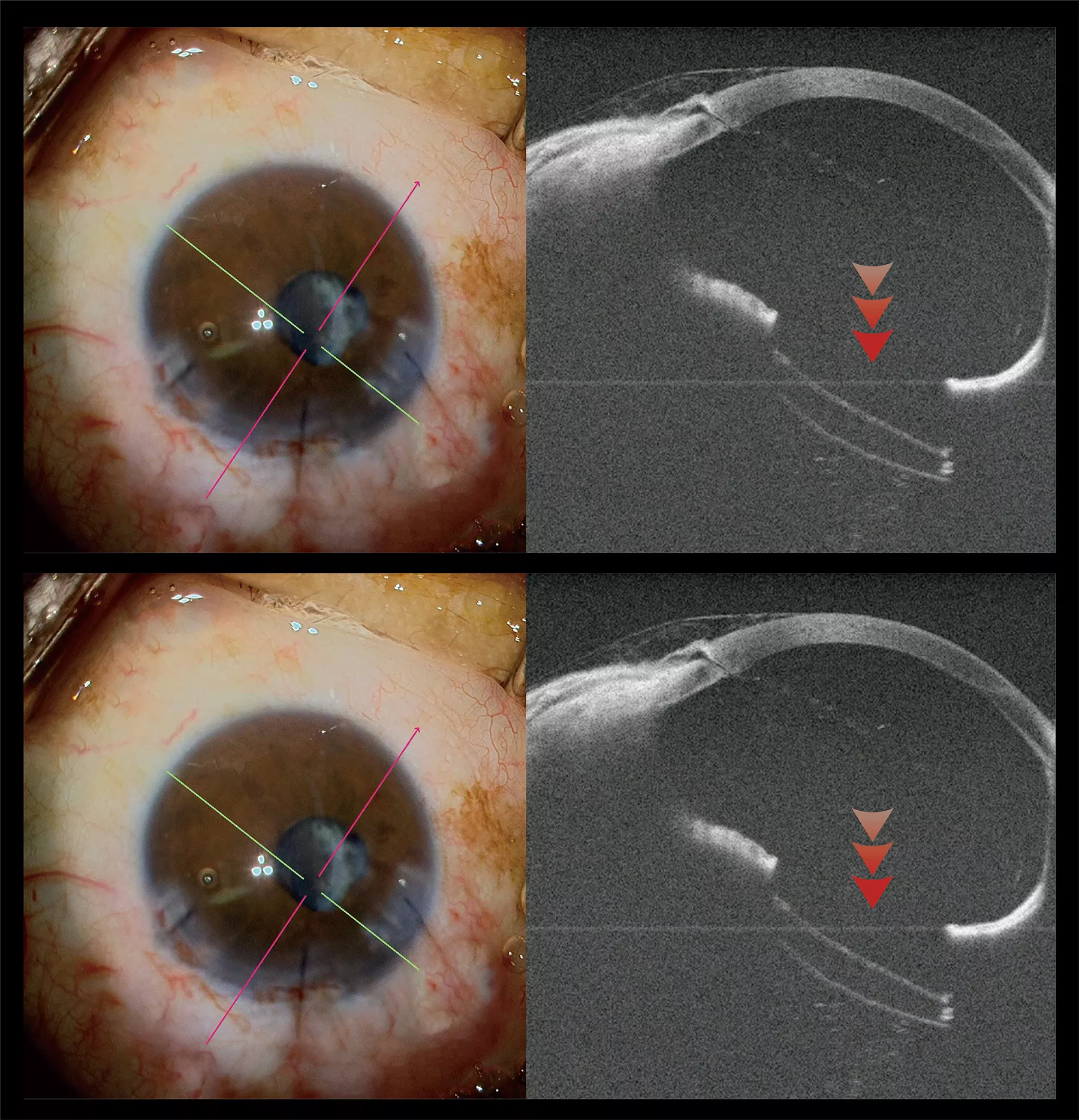 Intraoperative SS-OCT-IOL implantation in ocular trauma