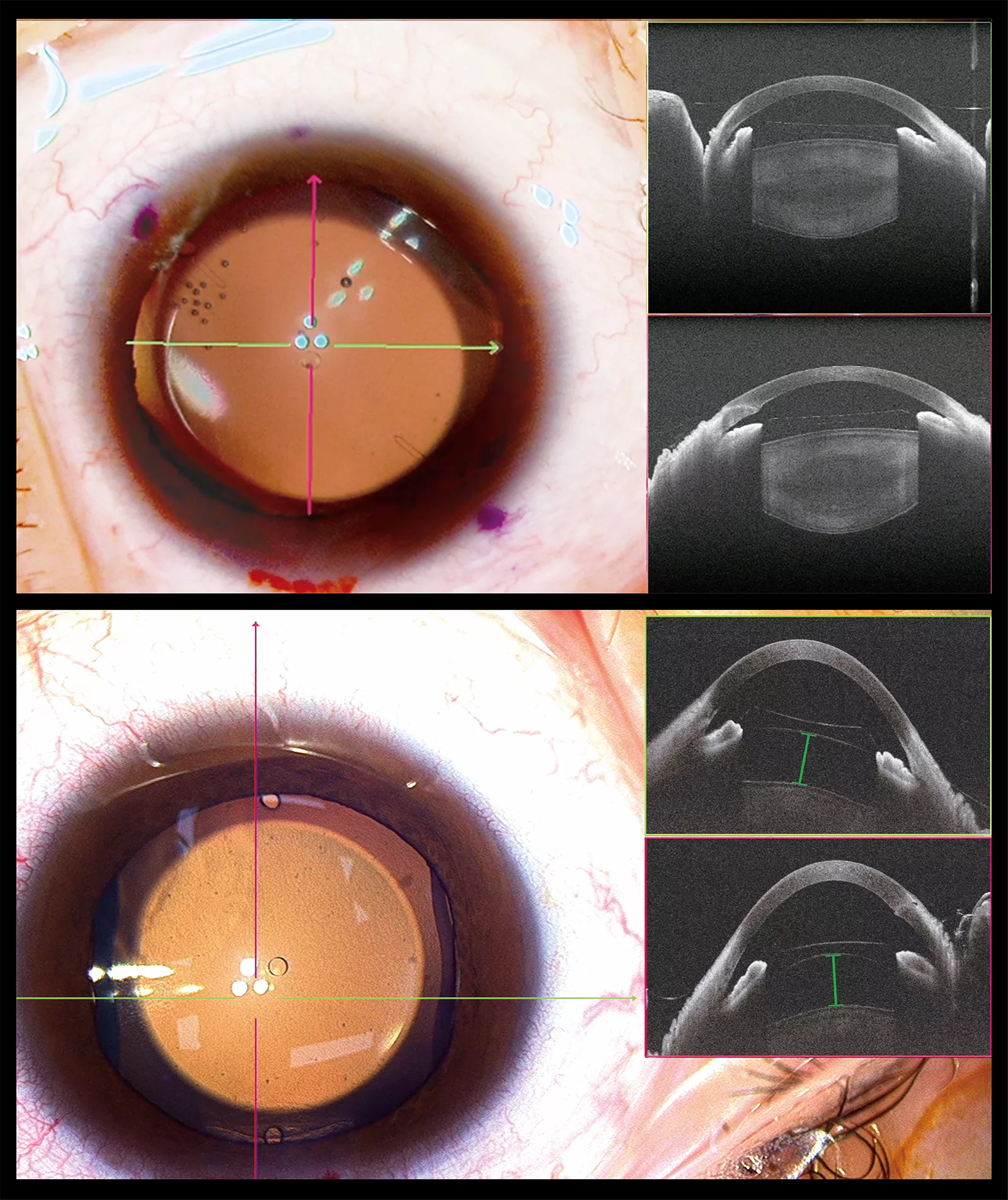 ICL intraoperative measurement