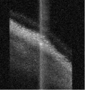 posterior staphyloma